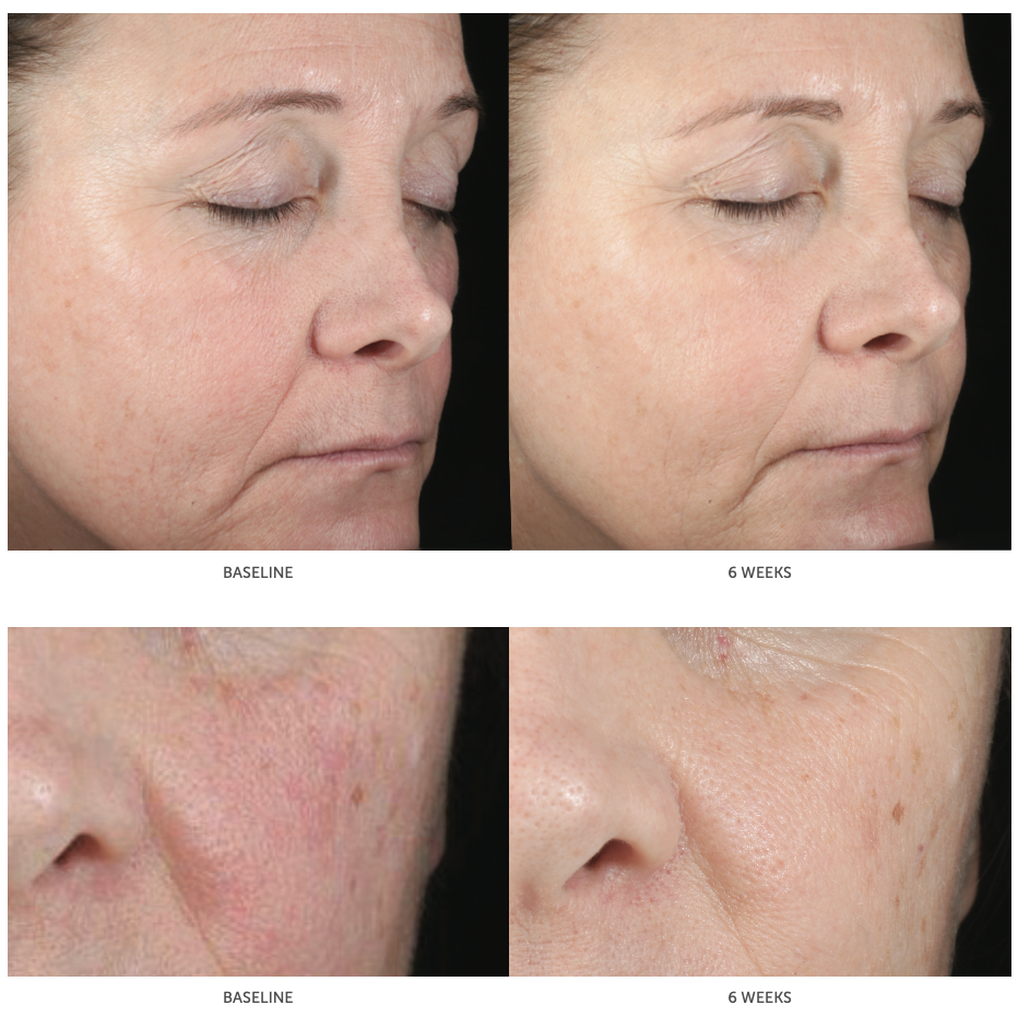 Hyaluronic Acid Serum